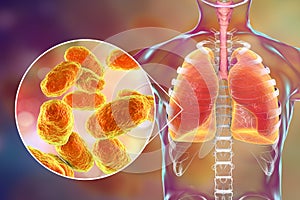 Pneumonia caused by Haemophilus influenzae bacteria, medical concept