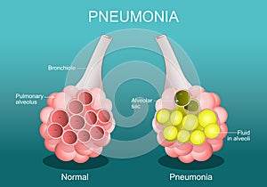 Pneumonia. Cross section of normal alveolus, and Alveoli are filled with fluids