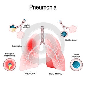 Pneumonia. Difference and Comparison of healthy lungs bronchioles and alveoli and pneumonia