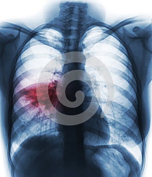 Pneumonia & x28; film chest x-ray show alveolar infiltrate at right middle lung & x29;