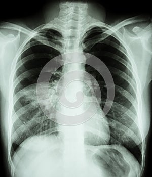 Pneumonia photo