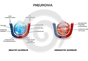 Pneumonia and healthy alveoli