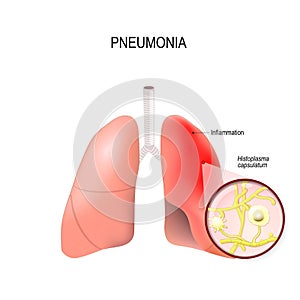 Pneumonia or Histoplasmosis. Normal and inflammatory condition o photo