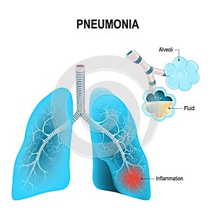 Pneumonia. human lungs, and inflamed alveoli