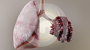 Pneumonia illness, healthy lungs and disease lungs, Human Lungs cancer, Cigarette smokers, cancerous malignant tumor