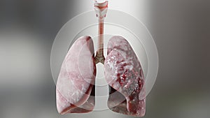 Pneumonia illness, healthy lungs and disease lungs, Human Lungs cancer, Cigarette smokers, cancerous malignant tumor