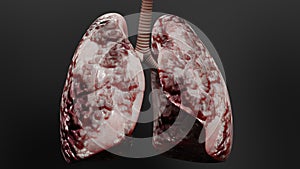 Pneumonia illness, healthy lungs and disease lungs, Human Lungs cancer, Cigarette smokers Lung disease, asthma infection