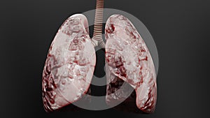 Pneumonia illness, healthy lungs and disease lungs, Human Lungs cancer, Cigarette smokers Lung disease, asthma infection