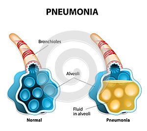 Pneumonia. Illustration shows normal and infected