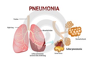 Pneumonia, Lobar pneumonia, isolated vector illustration on White background