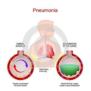 Pneumonia. Lung infection. Alveoli with fluid