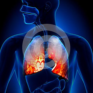 Pneumonia - Lungs Inflammatory Condition - anatomy