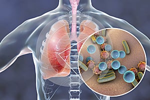 Pneumonia, medical concept, illustration showing human lungs and close-up view of microbes in lungs photo