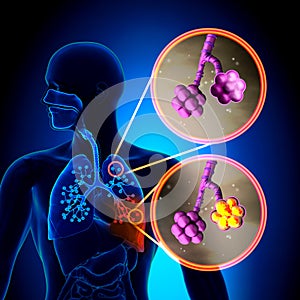 Pneumonia - Normal alveoli vs Pneumonia