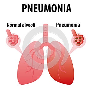 Pneumonia. Normal and infected alveoli. Healthy and ilness lungs cartoon flat icon for web design isolated on white background. Sc photo