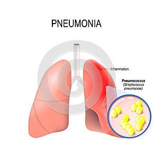 Pneumonia. Normal and inflammatory condition of the lung. photo