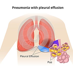 Pneumonia with pleural effusion. Close up of the alveioli with pus photo