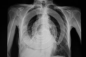 pneumonia right lower lung