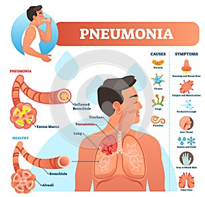 Pneumonia vector illustration. Labeled diagram with causes and symptoms.