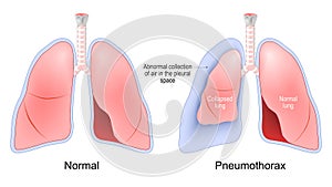 Pneumothorax. Normal, and collapsed lungs