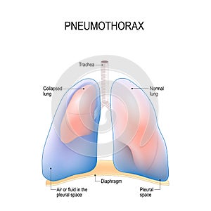 Pneumothorax. Collapsed lung.