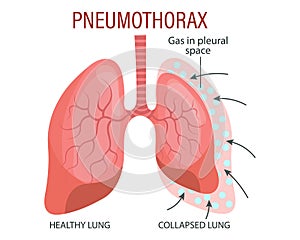 Pneumothorax, a lung disease. Healthcare. Medical infographic banner, illustration