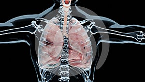Pneumothorax, Normal lung versus collapsed, symptoms of pneumothorax, pleural effusion, empyema photo