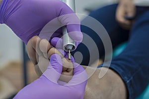 Podiatrist is removing a corn from a patient via drilling tool