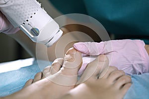 Podiatrist treating onychomycosis with a laser