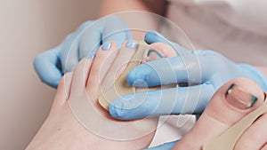 Podiatrists hands in blue medical gloves insert a silicone fixator to a client's foot with inrown nail. Closeup. The