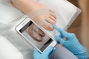 Podologist compares the results after ingrown toenails removal using a photo on a smartphone.