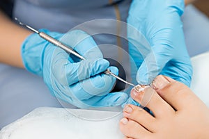 A podologist examines toenails affected by a fungal infection. Medical pedicure in the clinic