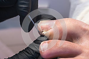 Podologist uses a curette to remove a callus on the toe