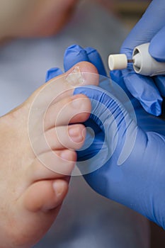 Podology treatment. Podiatrist treats foot. Podiatry doctor or dermatologist treats photo