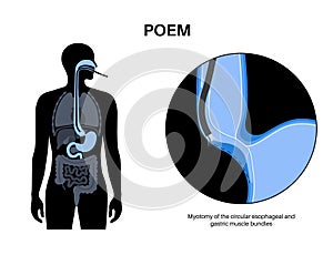 POEM medical poster