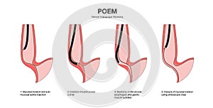 POEM medical poster