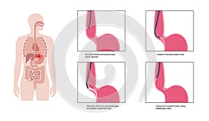 POEM medical poster photo