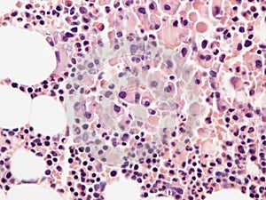 POEMS syndrome in bone marrow.