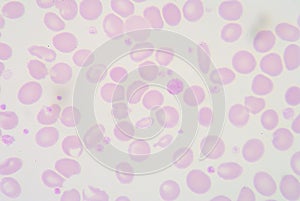 Poikilocytosis