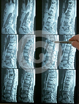 Pointing to an mri of lumbar spine