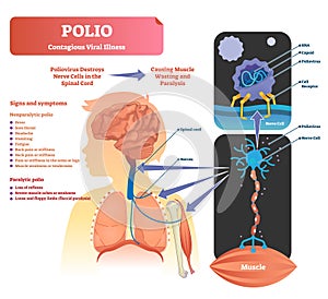 Polio vector illustration. Labeled medical virus infection symptoms scheme.