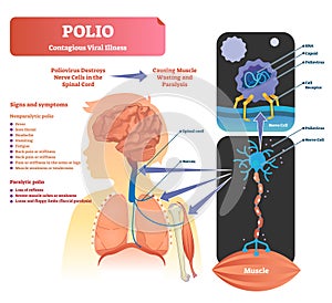 Polio vector illustration. Labeled medical virus infection symptoms scheme. photo