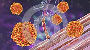 Polio viruses affecting motor neurons