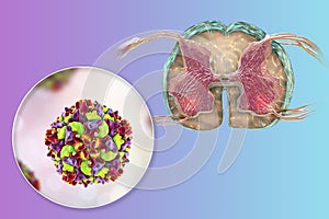 Polio viruses affecting motor neurons