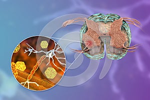 Polio viruses affecting motor neurons