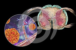 Polio viruses affecting motor neurons