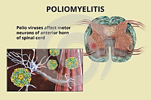 Polio viruses affecting motor neurons