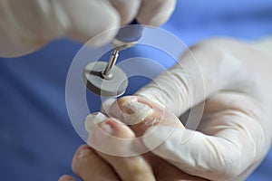 chiropody lathe that polishes onychomycosis infected toenails photo