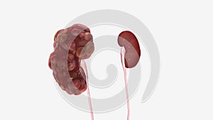 Polycystic kidney disease is a disease in which clusters of cysts develop causing your kidneys to grow and lose function over time
