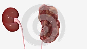 Polycystic kidney disease is a disease in which clusters of cysts develop causing your kidneys to grow and lose function over time